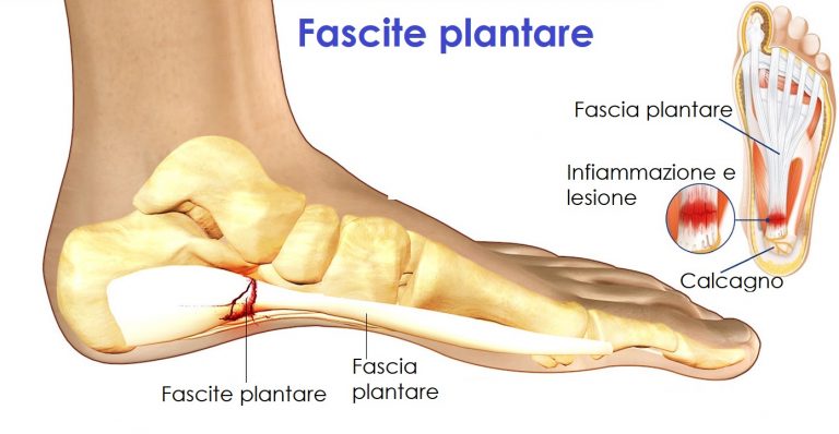 Dolore al piede nel podista: quando la causa è un nervo